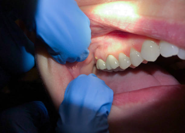 Best Emergency Gum Treatment in North Little Rock, AR