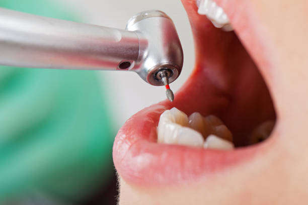 Best Emergency Treatment for Dental Infections or Abscesses in North Little Rock, AR